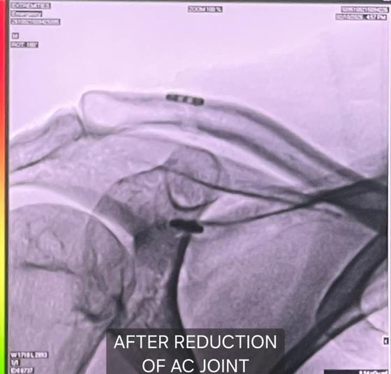 Fluoroscopy after reduction of AC joint