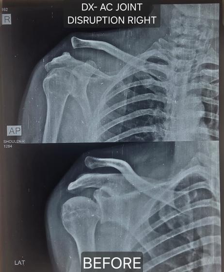 X-ray before: AC joint disruption of right shoulder