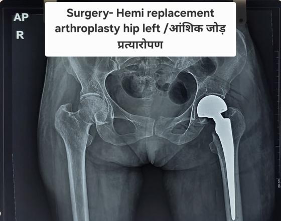X-ray after: hemi-replacement arthroplasty of hip