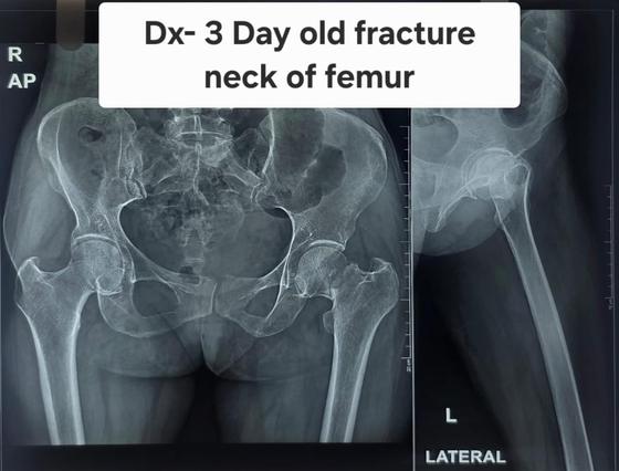 X-ray before: fracture neck of femur