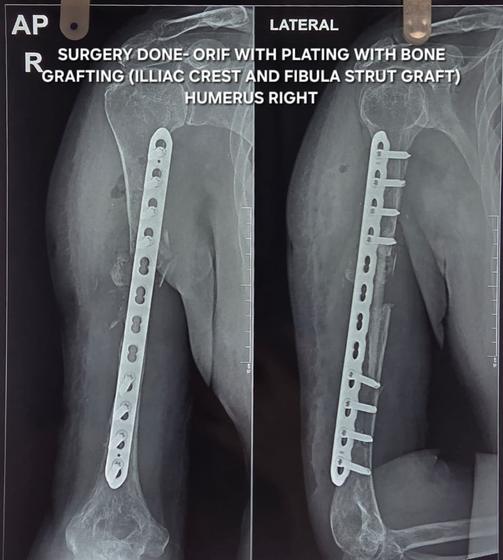 X-ray after: plating with bone grafting of humerus