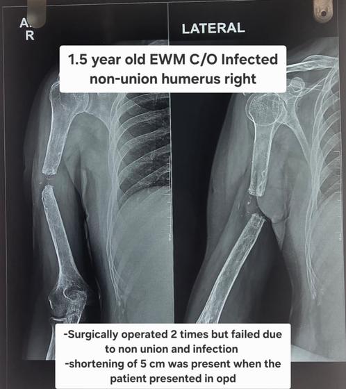 X-ray before: infected non-union of right humerus