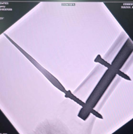 Femur nailing seen on C-arm