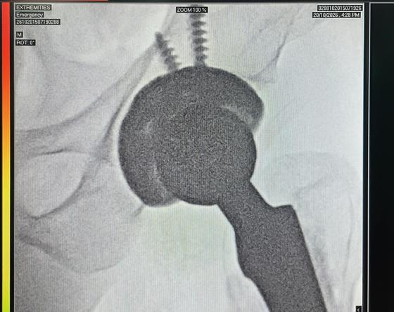 Hip implant seen on C-arm during surgery